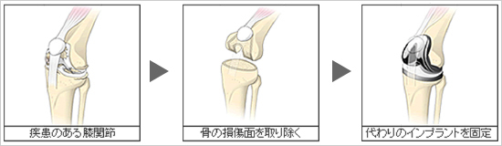 MIS 手術について