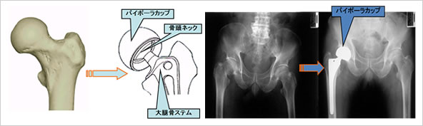 人工骨頭挿入術の説明