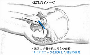 MISテクニックを使用した場合の傷跡